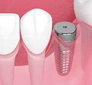 Digital illustration of dental implant