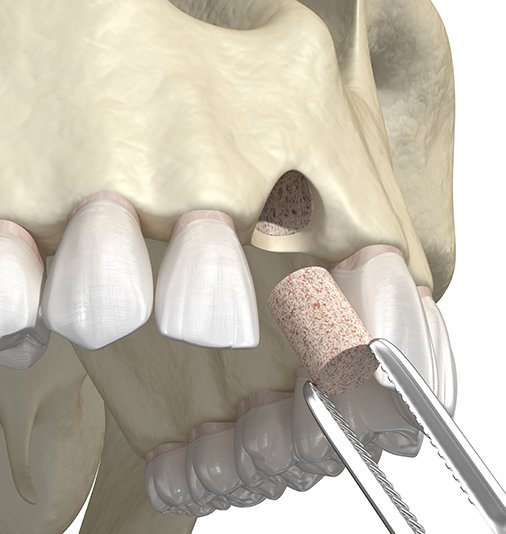 Animated smile during bone grafting treatment